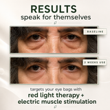 RevitalEyes 2-in-1 Red Light Therapy + EMS Eye Device
